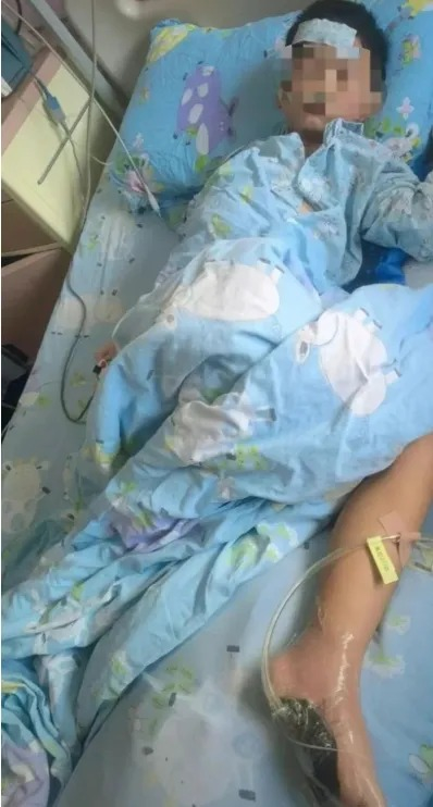 6歲男童沙灘光腳踩到死魚后高燒進ICU，醫生提醒