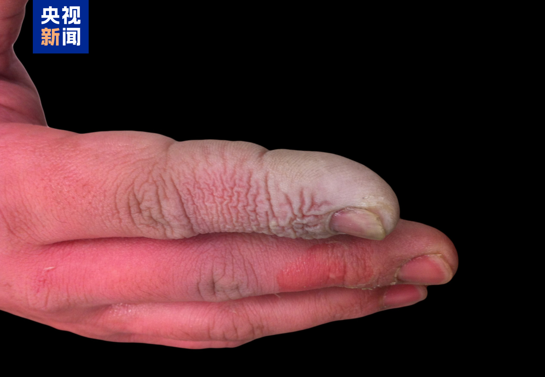 女子誤碰“化骨水”身亡,專家:少量接觸也可致命