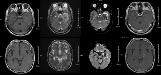 30歲小伙長期熬夜智力退回3歲 年輕人患“腦膜炎”病例為何頻發